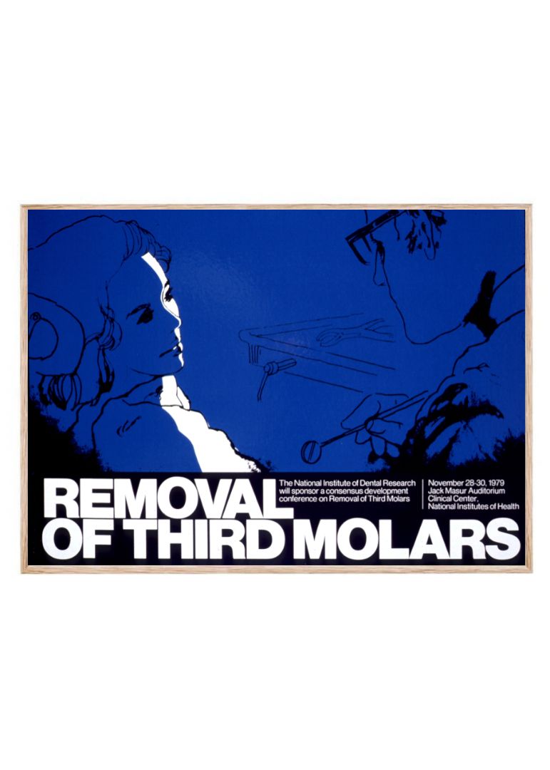Removal of third molars
