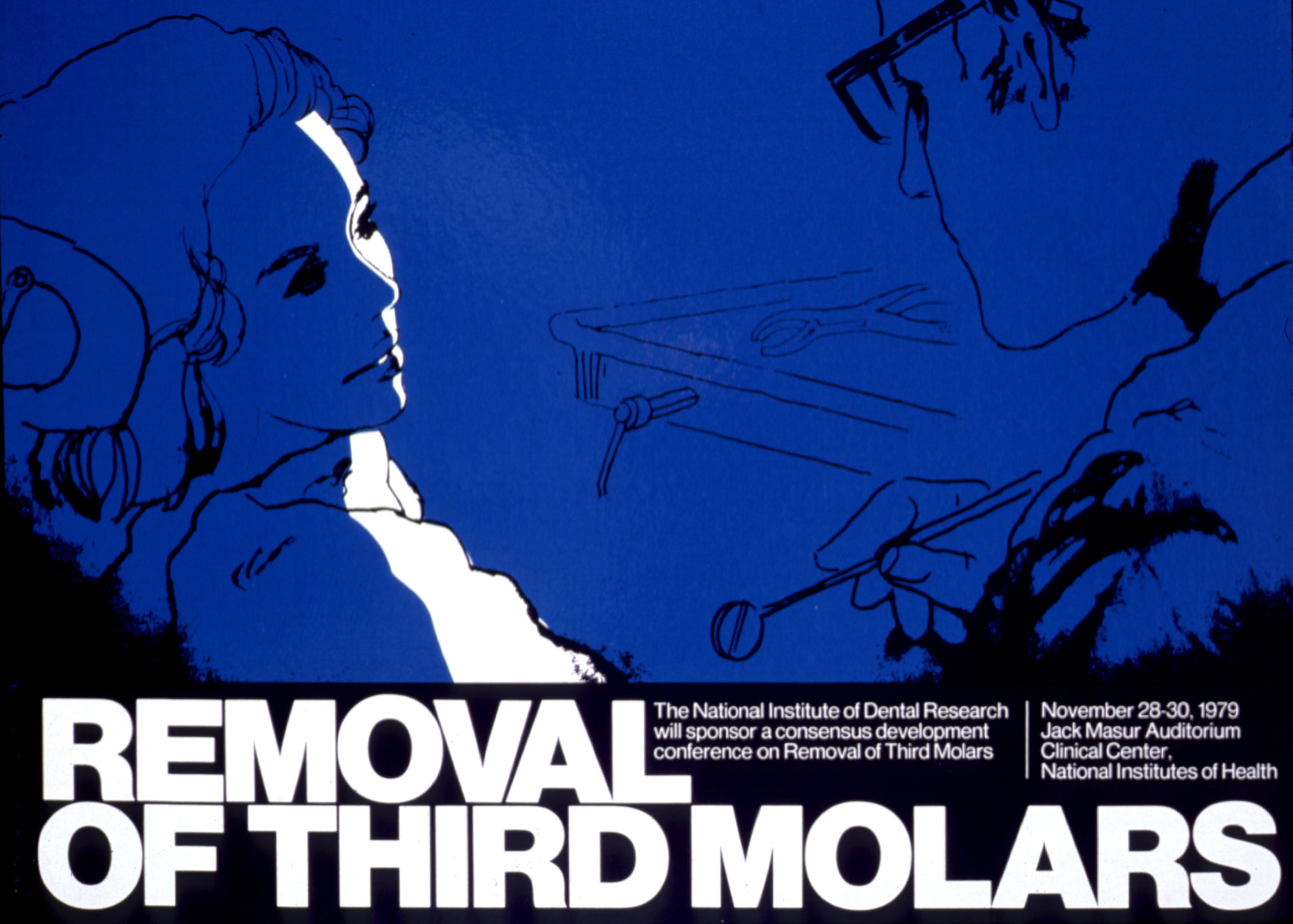 Removal of third molars